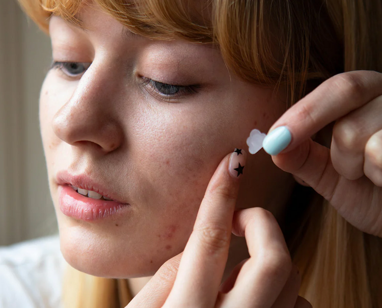 Why do teenagers get acne?