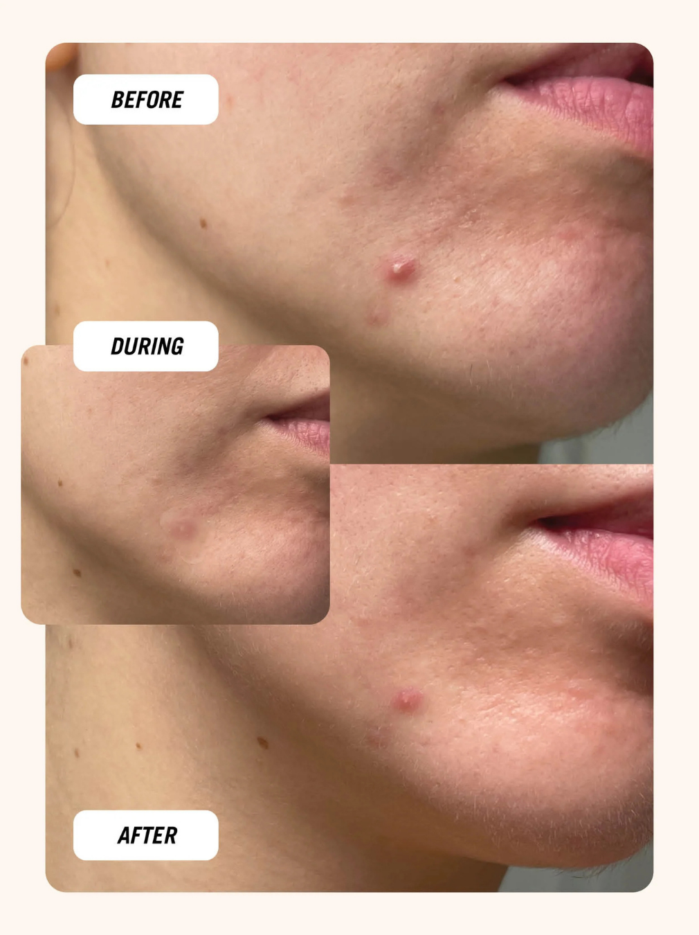 Cloud Patch Hydrocolloid Centella Spot Care